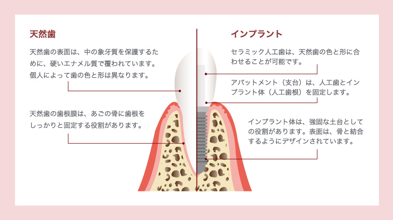 画像:インプラントの説明