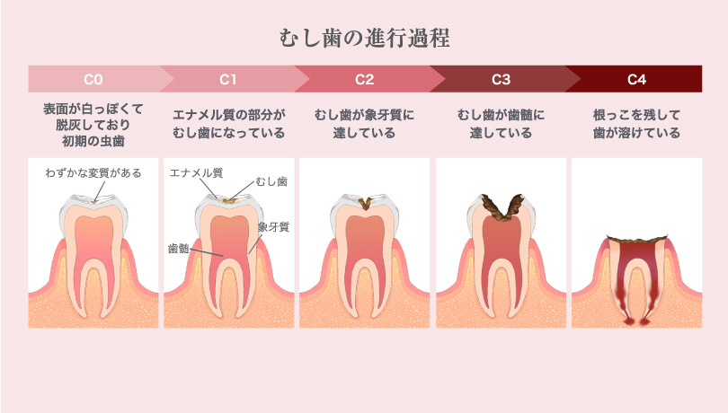 画像：虫歯の進行過程